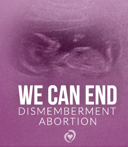 Dismemberment_abortion.jpg